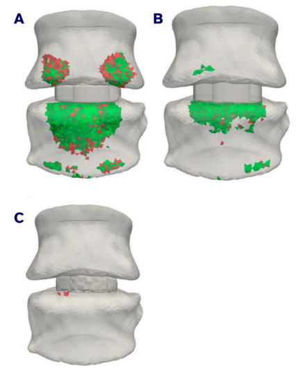 Overloaded bony structures comparison across implant types